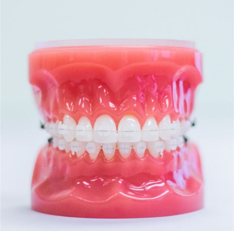 clear braces on model