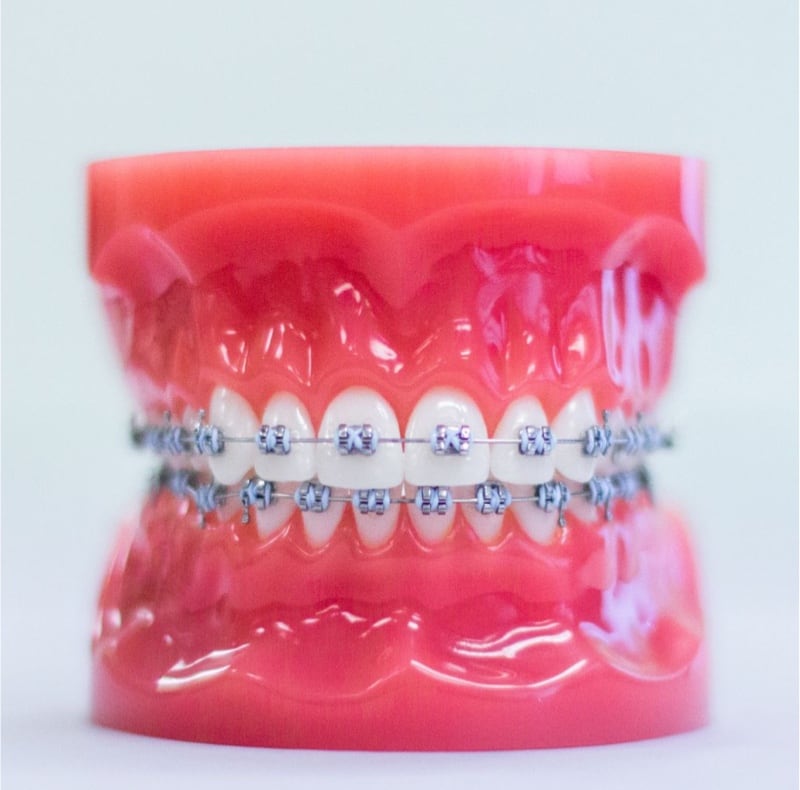 metal braces on model