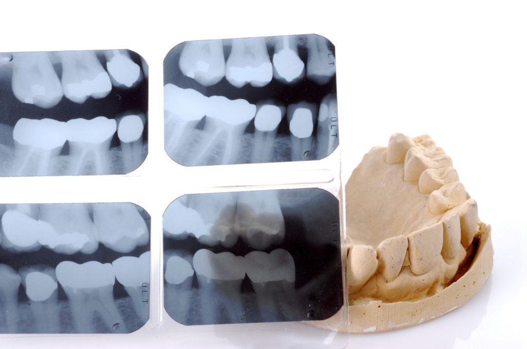 dental x-ray and mold