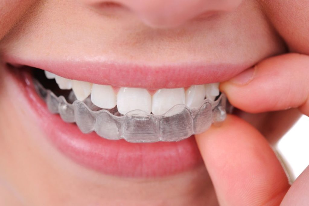 Invisalign: Fact or Fiction